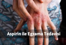 Aspirin ile Egzama Tedavisi