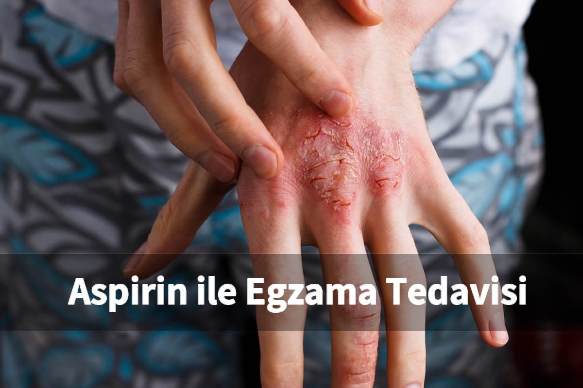 Aspirin ile Egzama Tedavisi