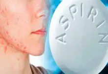 Aspirin ile Sivilce Tedavisi
