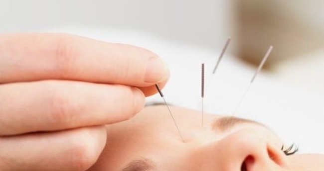 Akupunktur ile Zayıflama