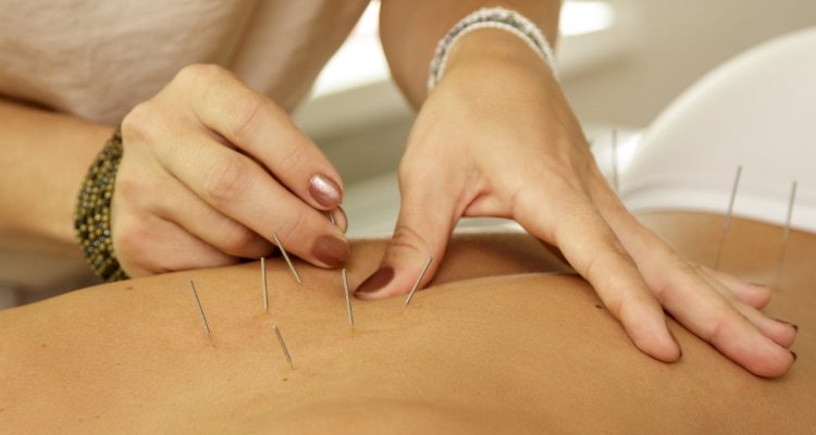 Akupunktur Nedir