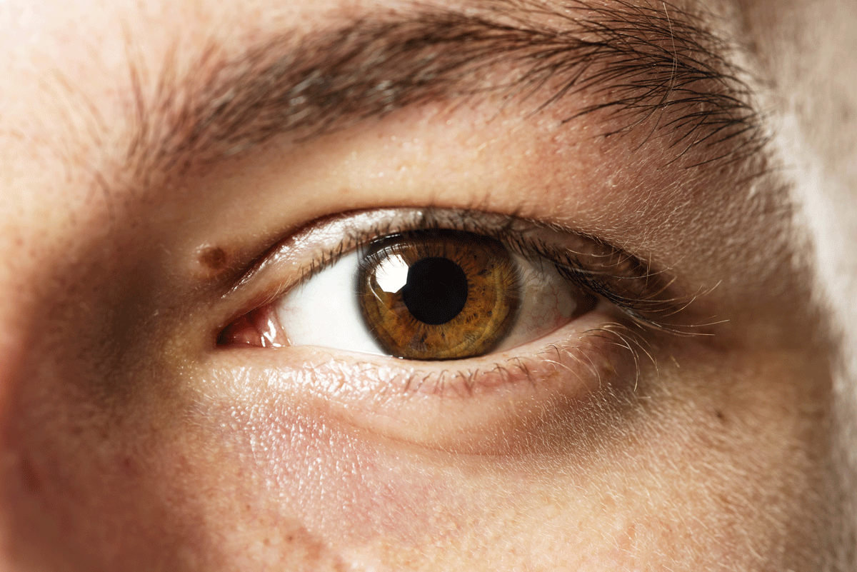 Göz Migreni Nedir? Göz Migreni Çeşitleri