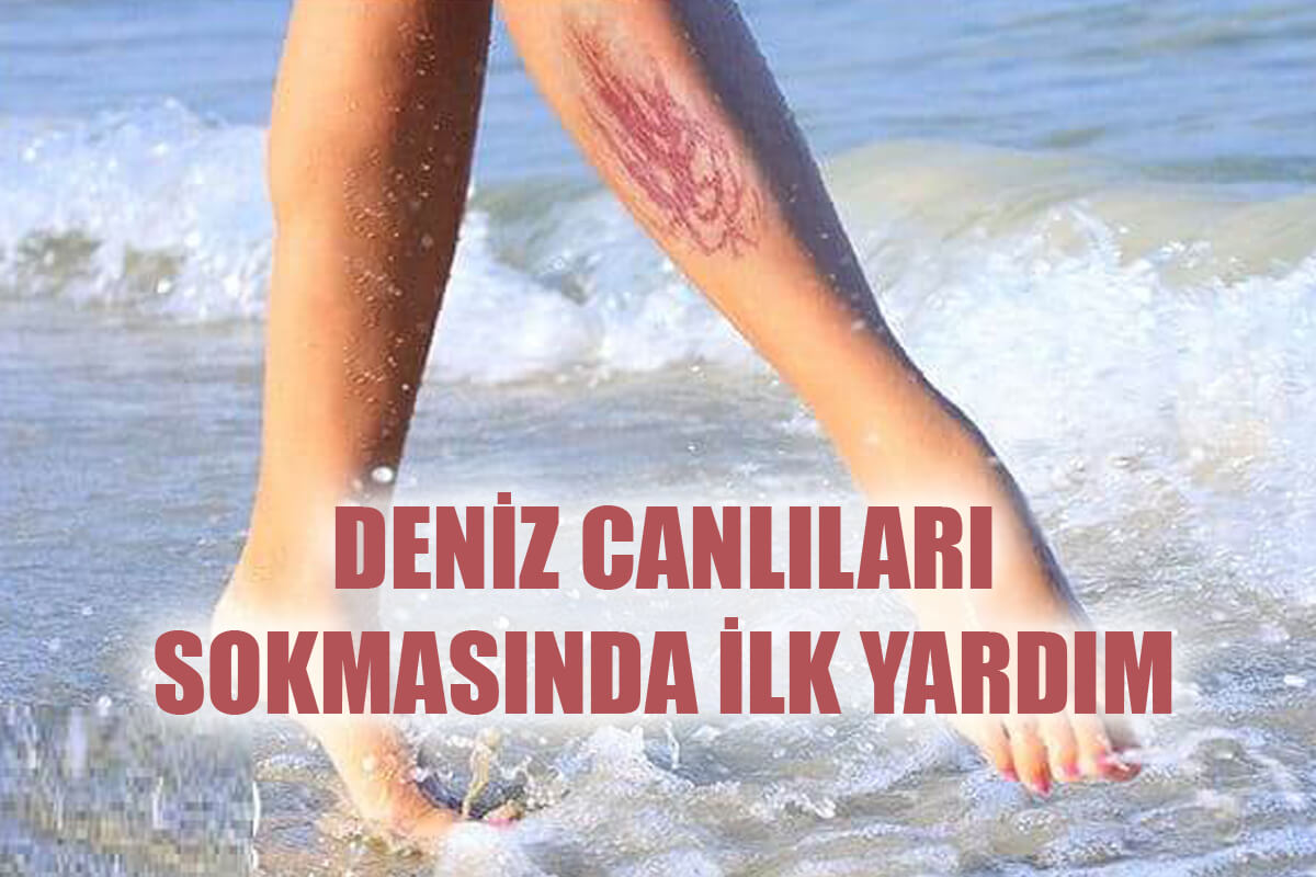 Deniz Canlıları Sokmasında Belirtiler Nelerdir?