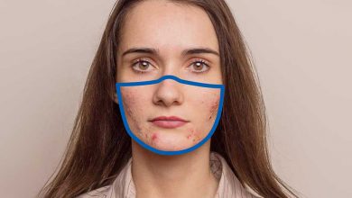 Maske Aknesi Maskne Nedir? Maskne Tedavi Yöntemleri 2026 Muz Kabuğu Maskne Nedir? Maskne Tedavi Yöntemleri