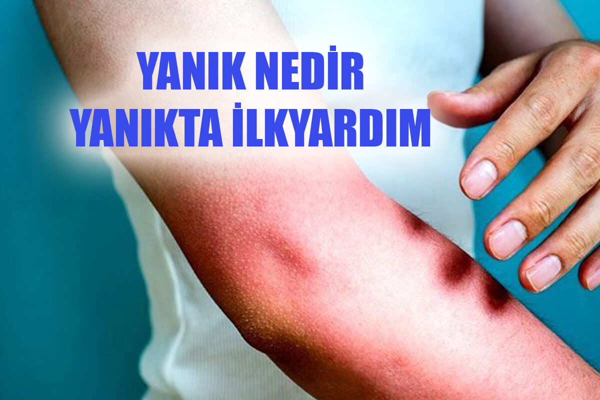 Yanık Nedir? Yanık Türleri Nelerdir? Yanıklarda İlkyardım Uygulaması