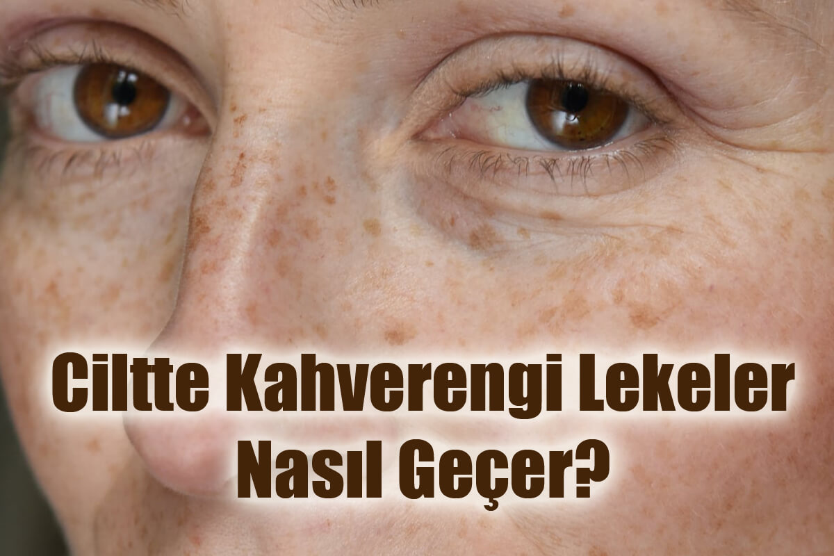 Ciltte Kahverengi Lekeler Nasıl Geçer?