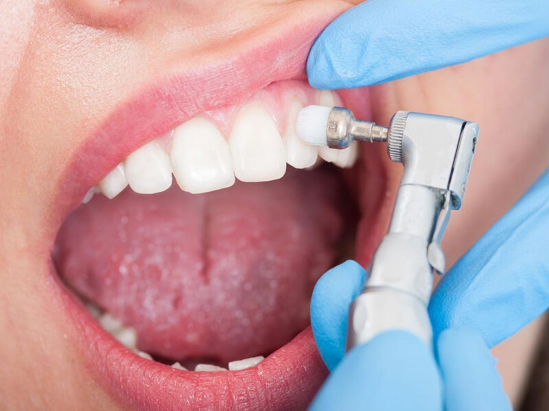 Diş Taşı Temizliğinin Ne Sıklıkla Yaptırılması Gerekir?