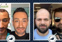 Saç Ekimi Sonrası Doğal Görünümlü Saçlar – Smile Hair Clinic 2023 İrmik Tatlısı Şerbeti