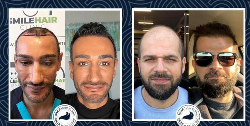 Saç Ekimi Sonrası Doğal Görünümlü Saçlar – Smile Hair Clinic 2025 Saç Ekimi Sonrası Doğal Görünümlü Saçlar – Smile Hair Clinic 2025