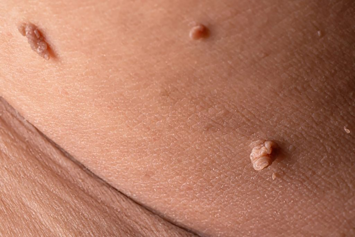Genital Siğil Neden Olur? Belirtileri, Tedavisi ve HPV Aşısı 2025 Genital siğil neden olur Genital Siğil Neden Olur? Belirtileri, Tedavisi ve HPV Aşısı