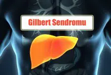 Gilbert Sendromu Nedir? Oluşumu, Semptomları ve Tedavisi