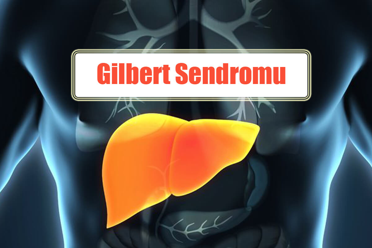 Gilbert Sendromu Nedir? Oluşumu, Semptomları ve Tedavisi