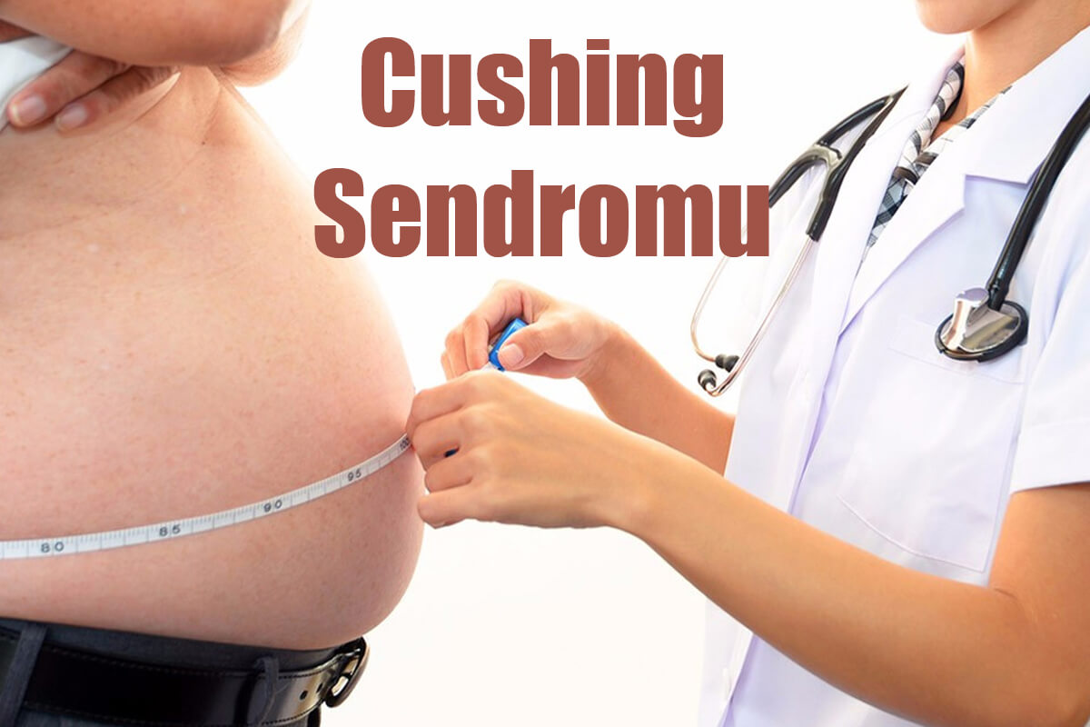 Cushing Sendromu Nedir? Belirtileri ve Tedavisi