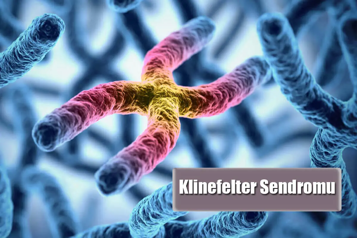 Klinefelter Sendromu Nedir? Sebepleri Nelerdir? 2025 Klinefelter Sendromu Klinefelter Sendromu Nedir? Sebepleri Nelerdir?