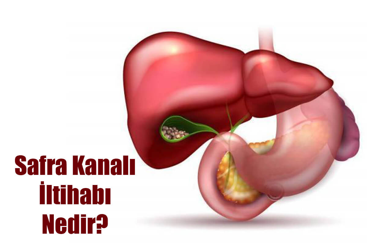 Kolanjit (Safra Kanalı İltihabı) Nedir?