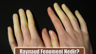 Raynaud Fenomeni Nedir? Nedenleri, Semptomları, Tedavi Yöntemleri