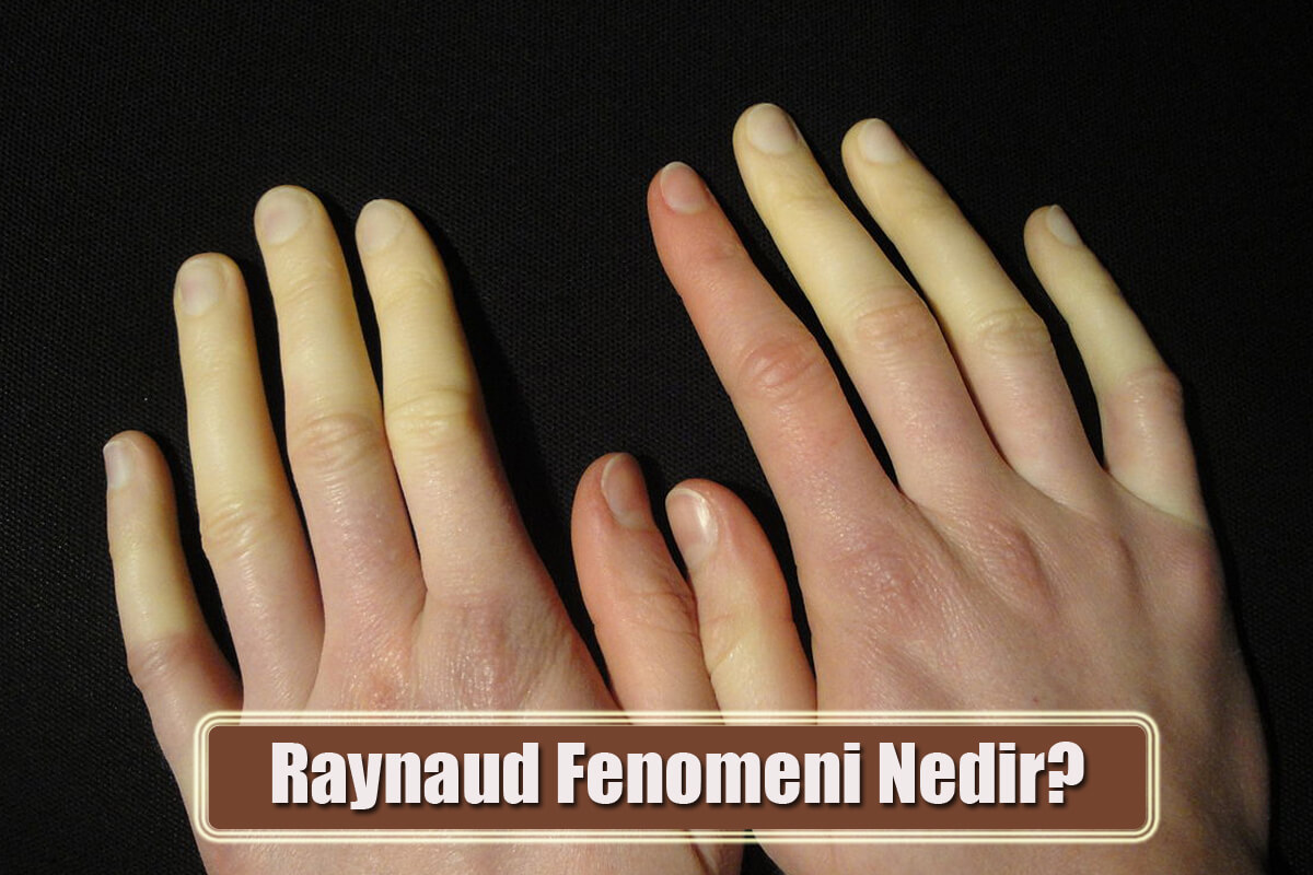 Raynaud Fenomeni Nedir? Nedenleri, Semptomları, Tedavi Yöntemleri