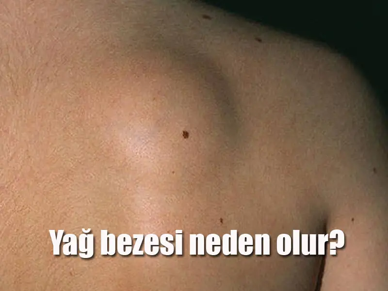 Yağ Bezesi Nedir? Yağ Bezesi (lipoma) Nasıl Geçer? 2026 Yağ bezesi nedir Yağ bezesi neden olur?