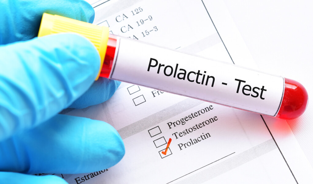 Prolaktin yüksekliği ne anlama gelir Prolaktin Hormonu Nedir