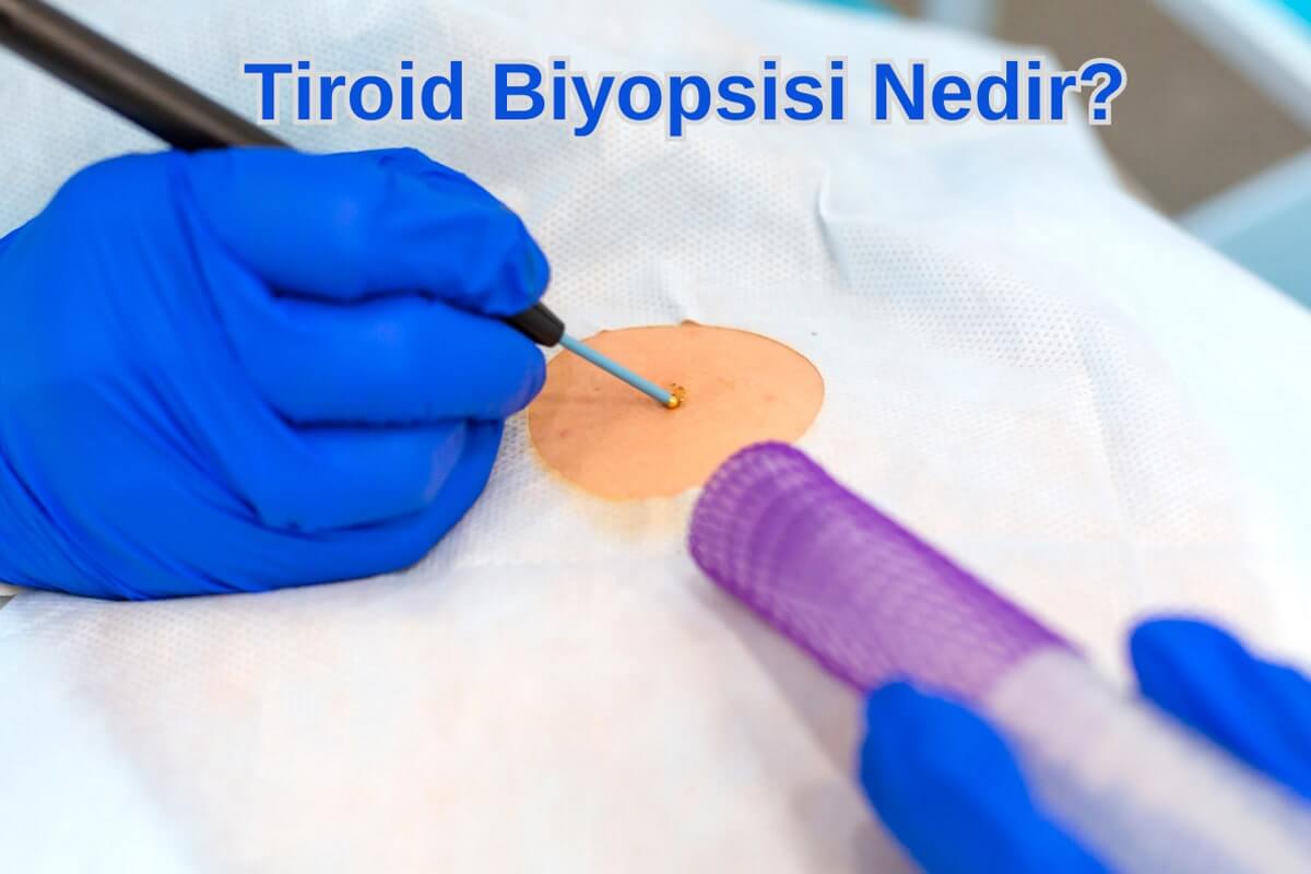 Tiroid Biyopsisi Nedir?